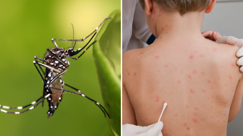 Salud: la situación actual sobre el dengue, sarampión y fiebre tifoidea en Zona Oeste