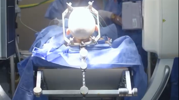 Otro hito para el Hospital Posadas: primero en colocar un implante para la epilepsia